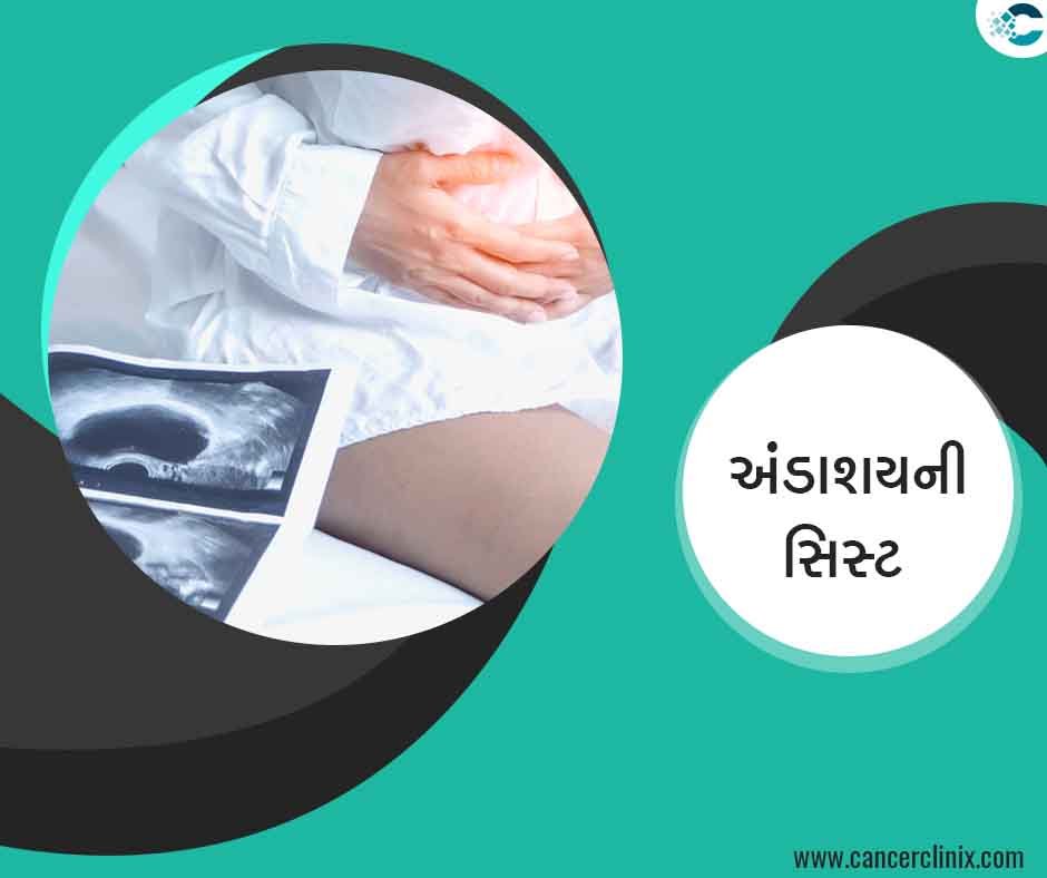 ઇન્ડિયન ઓવરી કેન્સર ઇન્સ્ટિટ્યૂટ (IOCI) અમદાવાદ ખાતે મહિલા દર્દીને પેલ્વિક સોનોગ્રાફી રિપોર્ટ અને ઓવેરિયન સિસ્ટના પ્રકારો સમજાવતા કેન્સર નિષ્ણાત ડૉક્ટર.