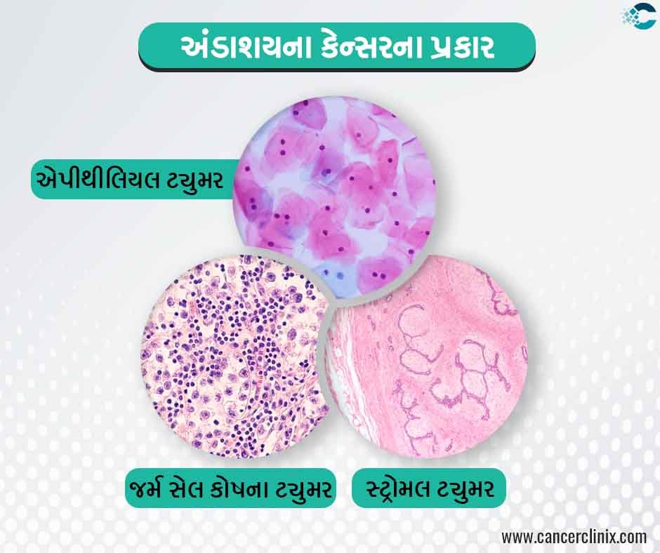 અંડાશયના કેન્સરના મુખ્ય પ્રકારો (Primary Types of Ovarian Cancer)
