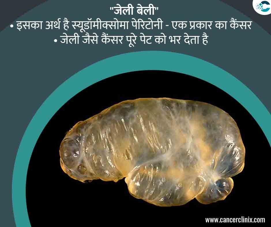 अहमदाबाद के शाह्स कैंसर सेंटर में एक मरीज और उनके परिवार को सीटी स्कैन रिपोर्ट के जरिए जेली बेली (सूडोमायक्सोमा पैरिटोनी) की स्थिति समझाते हुए वरिष्ठ ऑन्को-सर्जन।
