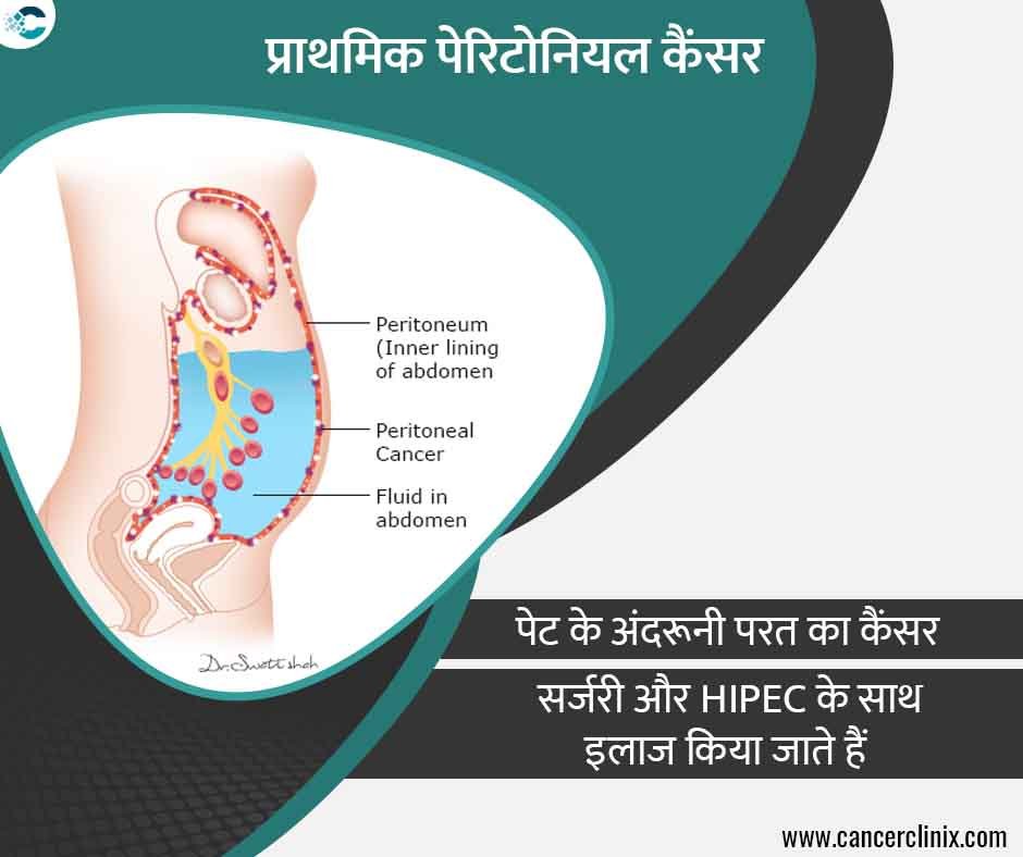 अहमदाबाद के शाह्स कैंसर सेंटर में एक महिला मरीज और उनके परिवार को डिजिटल स्क्रीन पर पेट की पेरिटोनियम झिल्ली और प्राथमिक पेरिटोनियल कैंसर की स्थिति समझाते हुए वरिष्ठ विशेषज्ञ।