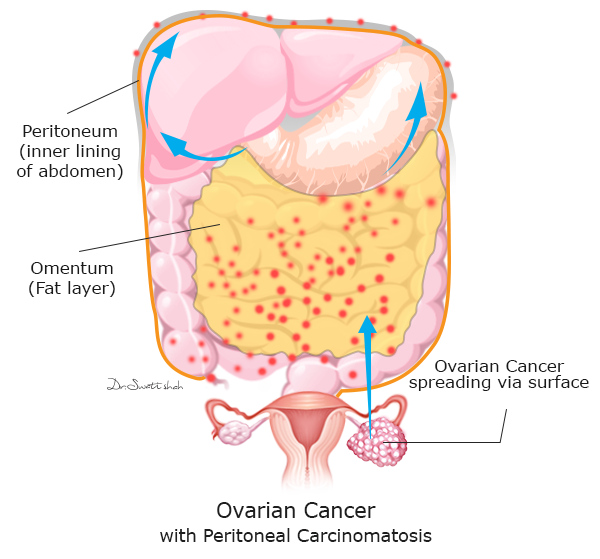 Recurrent Ovarian Cancer