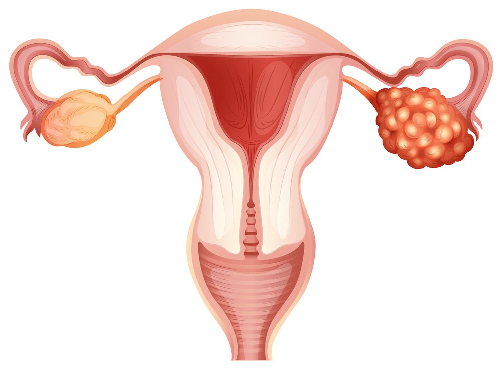 Recurrent Ovarian Cancer