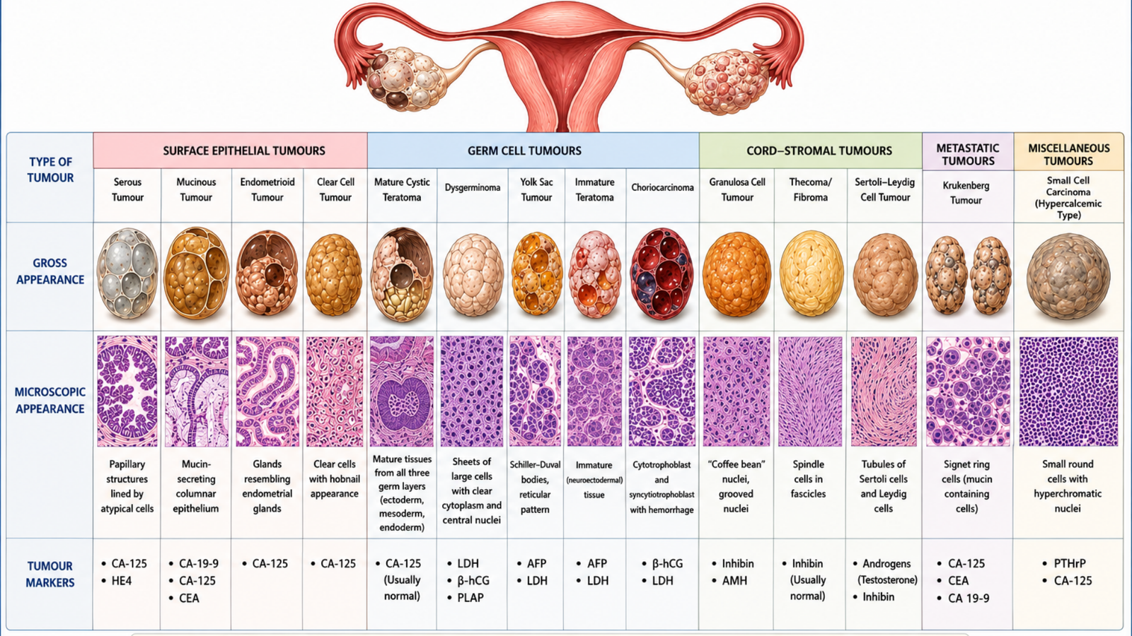 Ovary Tumour