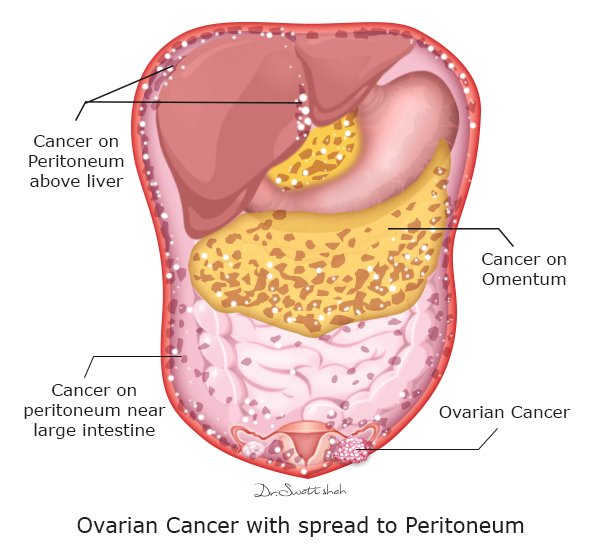 Advanced Metastatic