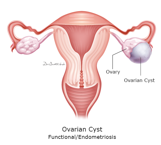 Ovary Cyst