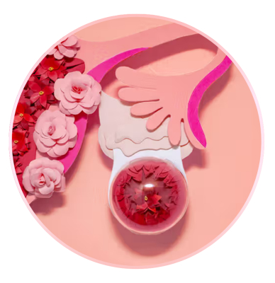 1-Early-Stage Ovarian Cancer